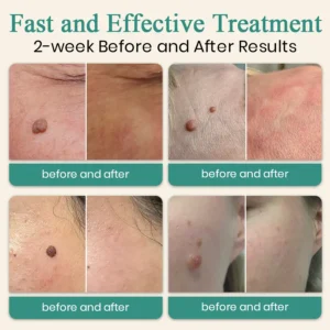 DAFEILA® LumeSkin Mole and Wart Instant Removal Laser Pen ACE