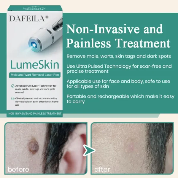 DAFEILA® LumeSkin Mole and Wart Instant Removal Laser Pen ACE