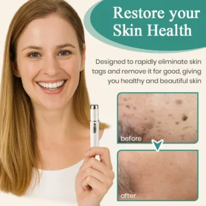 DAFEILA® LumeSkin Mole and Wart Instant Removal Laser Pen ACE