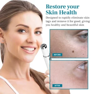 DAFEILA® LumeSkin Mole and Wart Removal Laser Pen 💜_Ultra02