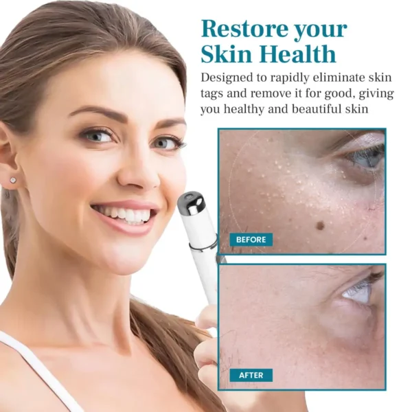 DAFEILA® LumeSkin Mole and Wart Removal Laser Pen 💜_Ultra02