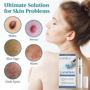 DAFEILA® LumeSkin Mole and Wart Removal Laser Pen 💜_Ultra02