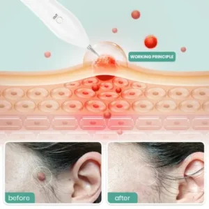 Dafeila® Advanced Plasma Laser Spot Cleaning Pen