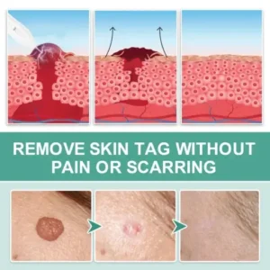 Dafeila® Advanced Plasma Laser Spot Cleaning Pen