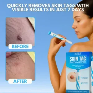 Dafeila® Skin Tag Removal Pen