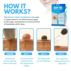 Dafeila® Skin Tag Removal Pen